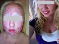 laser-acne-treatment-before-and-after-1
