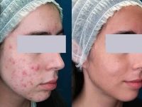 laser-acne-treatment-before-and-after-6
