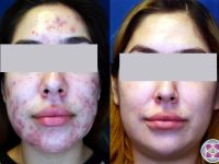 laser-acne-treatment-before-and-after-results-2