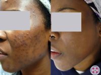 laser-acne-treatment-dark-skin