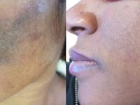 laser birthmark removal before and after