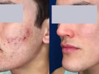 laser-cystic-acne-treatment-before-and-after-3