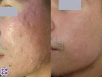 laser-scar-removal-before-after-2