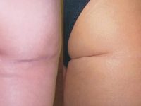 laser-scar-removal-before-after-3