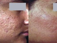 laser-scar-removal-before-after-4