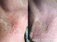 laser-spider-vein-removal-neck-male-before-and-after