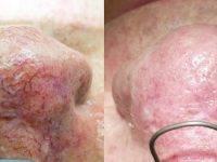 laser-spider-vein-removal-nose-before-and-after