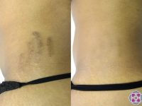 laser-stretch-mark-reduction-dark-skin