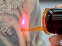 laser-tattoo-removal-q-switched-laser