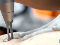 laser-tattoo-removal-yag-laser-ama-regen-med-skincare