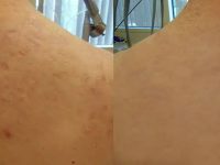 laser-treatment-for-acne-scars