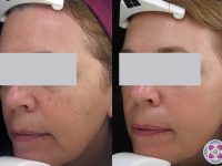 laser treatment for dark spots female