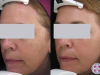 laser-treatment-for-dark-spots-female
