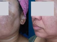 laser-treatment-for-melasma-before-and-after-12