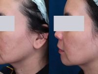 laser-treatment-for-melasma-before-and-after-13