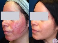 laser-treatment-for-rosacea-before-and-after