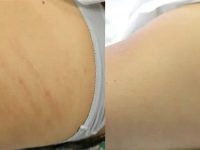 laser-treatment-for-stretch-marks