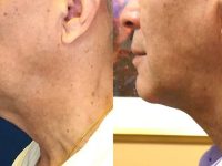laser-turkey-neck-removal-before-after