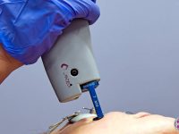 laser-vein-removal-pulsed-dye-laser