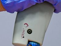 laser-vein-removal-v-beam