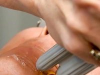 laser-vein-removal-veins-on-face