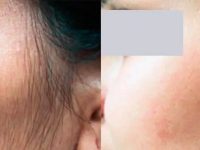 laserhairremovalbeforeandafter01