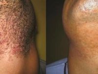 laserhairremovalbeforeandafter02