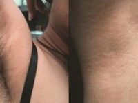 laserhairremovalbeforeandafter03