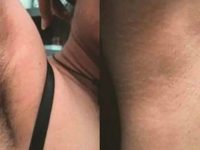 laserhairremovalbeforeandafter03