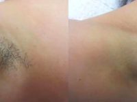 laserhairremovalbeforeandafter04
