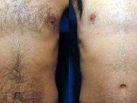 laserhairremovalbeforeandafter05