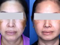 melasma-laser-treatment-before-and-after2