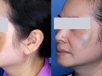 melasma-laser-treatment-before-and-after3