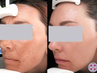 melasma-removal-from-face