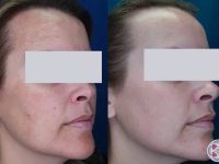 melasma-treatment-before-and-after-10