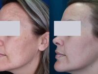 melasma-treatment-before-and-after-11