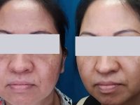 melasma-treatment-before-and-after-8