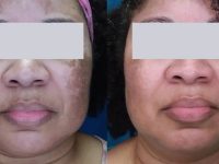 melasma-treatment-before-and-after-9