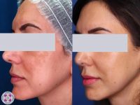 melasma-treatment-before-and-after