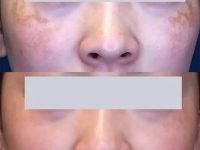 melasma-treatment-with-lasers-before-after-12