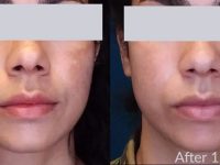 melasma-treatment-with-lasers-before-after-2 (1)