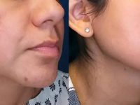 melasma-treatment-with-lasers-before-after