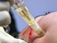 microneedling-side-of-face-with-miconeedling-pen