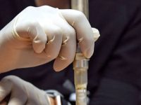 microneedling-stretch-mark-on-stomach