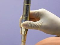 microneedling-stretch-marks-stomach-after-pregnancy