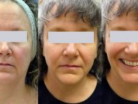neck-jowl-skin-tightening-before-after