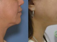 neck-lift-without-surgery-before-after-3