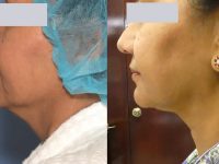 neck-skin-tightening-before-after-1
