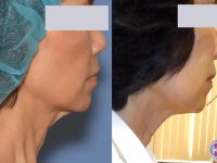 neck-skin-tightening-before-after-2