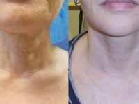 neck-tightening-before-and-after-7